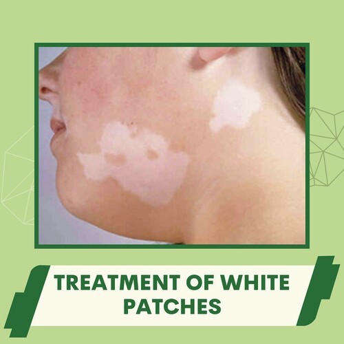 Treatment Of White Patches, Vitiligo, Melanogenesis, Katargam, Rander 