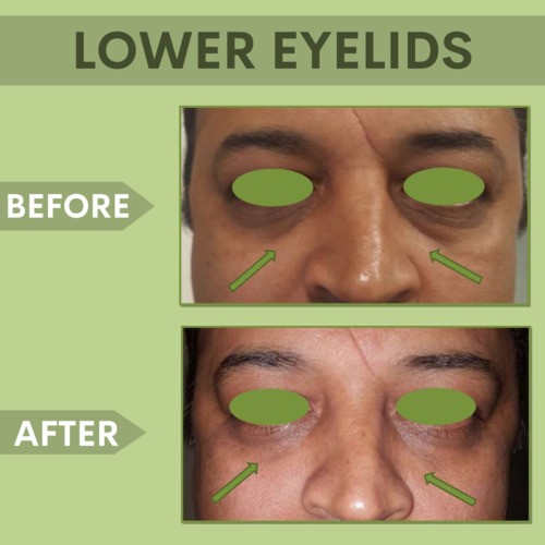 Lower Eyelid Botox Treatment, Botox and Filler Treatments Surat ...